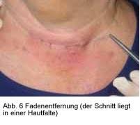 Außerdem erfahren sie, wie gefährlich der ablauf einer schilddrüsenoperation ist und ob eine narbe bleibt. Wundheilung Und Narbenbildung St Agatha Krankenhaus