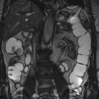 Er wird ihnen auch sagen, wie viel flüssigkeit sie insgesamt zu sich nehmen müssen. Virtuelle Mr Koloskopie Radiologisches Institut Ddr Artmann Dr Ratzenbock Wels