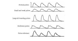 Pin By B On Cath Rcis Pulses Heart Wave Abnormal