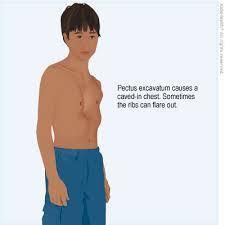 Flared ribs can be fixed or corrected by breathing the right way. Chest Wall Disorder Pectus Excavatum For Parents Nemours Kidshealth
