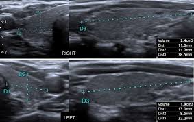 These problems can be broken down into 1 those concerning the production of hormone (too much. Assessment Of Thyroid Gland Vascularity With Superb Microvascular Imaging In Healthy Children And Its Relationship With Potential Factors