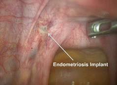 Endometriosis Cmc Women S Institute Charlotte Concord Nc