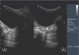 For a diagnostic ultrasound, the lubricating gel applied to the abdomen is wiped off at the end of the procedure and the patient can immediately resume normal activities. Ultrasound Of The Pediatric Female Pelvis Semantic Scholar