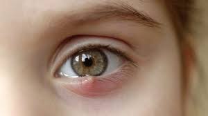Ia juga berisiko menjejaskan banyak bahagian badan seperti muka, leher, ketiak. Bisul Di Kelopak Mata Bagaimana Mengobatinya