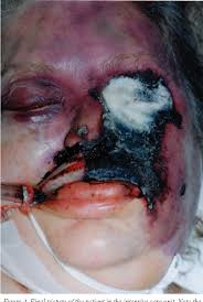 Rhinocerebral mucormycosis refers to an uncommon form of invasive fungal sinus infection. Figure 4 From Rhino Orbito Cerebral Mucormycosis A Case Report And Review Of The Literature Semantic Scholar
