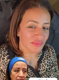 تحول كامل للوجه بالفيلر مع د. جود