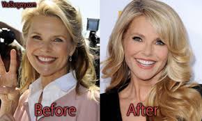 Pediatric plastic surgeons at the johns hopkins children's center in baltimore provide general and specialized surgical services for children and adolescents. Christie Brinkley Plastic Surgery Before And After Botox Pictures