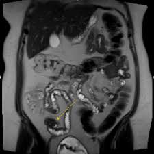 When the tissue grows abnormally outside the uterus, such as on the bowel, the endometrial tissue still thickens in a ct scan. Cureus Endometriosis Of The Small Bowel A Diagnostic Enigma