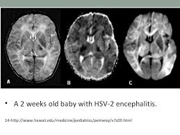 Lesions similar to cytotoxic edema, and lesions similar to vasogenic edema. Hsv Encephalitis Final