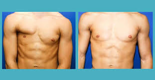 Absence or abnormality of the pectoralis in short, hand deformity and underdevelopment of the chest, on the same side of the body are the main for females, reconstructive surgery is held back till the breast development is complete. Poland Syndrome Signs Symptoms Surgery Dr Zoran Potparic