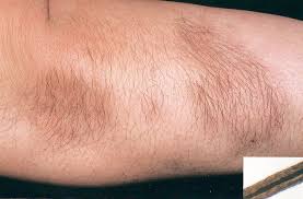Image result for Hypertrichosis