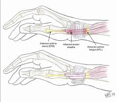 Both tendons and ligaments are dense regular connective tissue, because of its two properties: Why Does My Thumb Hurt Raleigh Orthopaedic