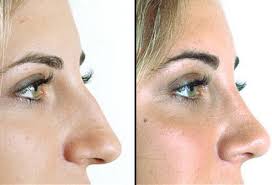 Nose Job Before And After A Rhinoplasty Commonly Termed A Nose Job Is A Procedure In Which The Nose Is Nose Surgery Rhinoplasty Rhinoplasty Before And After