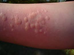 Nov 21, 2018 · stinging nettle (urtica dioica) has been a staple in herbal medicine since ancient times, such as to treat arthritis and back pain. Nettle Rash Stinging Nettle Sting