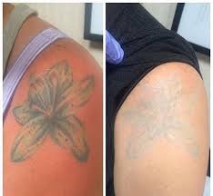 Queensland tattoo removal,tattoo removal queensland,victoria campbell,laser tattoo removal,skin needling,fades for coverups,tattoo removal. Tattoo Removal Brisbane S Specialist Clinic The Fiori Institute