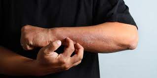 Menurut penelitian yang dilansir dari prevention.com, ternyata kulit kering bisa menjadi tanda awal dari penyakit berikut ini. Atasi Kulit Kering Dan Gatal Dengan Cara Pengobatan Ini
