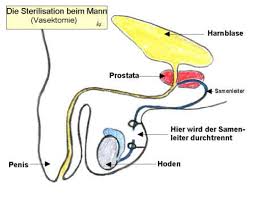 Meistens bedeutet es, … … dass man etwas nicht selbst macht. Urologenportal Sterilisation Des Mannes