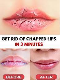 Chapped Lips - Get Rid Of Chapped Lips In 3 Minutes | Chapped Lips, Chapped  Lips Remedy, Dry Lips Remedy