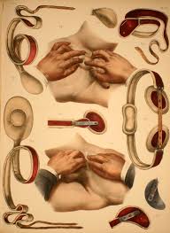 Image result for Hernia Reduction