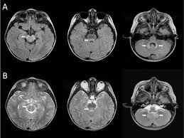 It is a common finding on brain mri and a wide range of differentials should be considered 1. Magnetic Resonance Imaging Features Of Pediatric Coxsackievirus Encephalitis