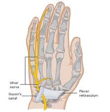 For concomitant ulnar nerve symptoms; Guyon Canal Syndrome Physiopedia