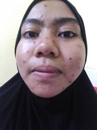 Kalau tak kena cara, habis satu badan cepat merebak dek kerana asyik menggaru. Niza Ahmad Com Cara Menghilangkan Parut Chicken Pox