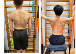 كيف نمنع اعوجاج العمود الفقري الوصول إلى مرحلة الخطر؟