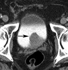 Image result for Helical CT Urogram