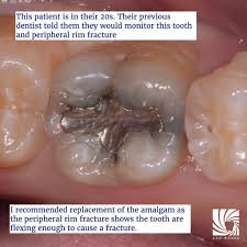 Image result for Occlusal