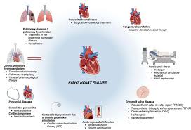Image result for Right Heart Failure