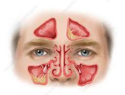 Symptoms include trouble breathing through the nose, loss of smell, decreased taste, post nasal drip, and a runny nose. Nasal Polyps Keyword Search Science Photo Library