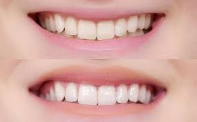Pin On Teeth Whitening Before After Results