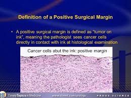 This rim is called a margin. Memorial Sloan Kettering Cancer Center Ppt Video Online Download