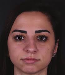 Nasal Base Retraction: A Treatment Algorithm