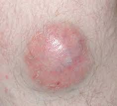 Merkel cell carcinoma is a skin cancer that is rare in type and needs immediate treatment. Metastatic Merkel Cell Carcinoma The Dawn Of A New Era Bmj Case Reports