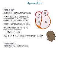 Image result for Myocarditis