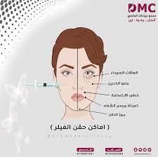 اماكن حقن الفيلر الهالات السوداء لتعبئه و ملئ الخدين لخطى الابتسامة لتعبئه و رسم الشفاه لبروز الذق insta photo ideas photo movie posters