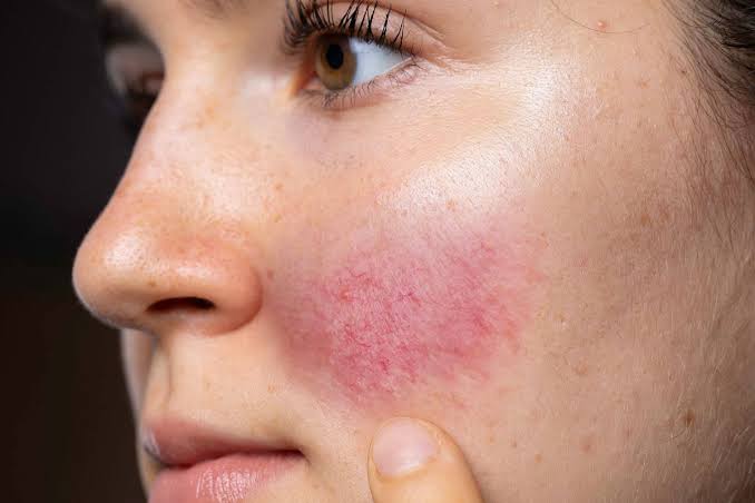 Rosacea Treatment Dubai | Redness & Skin Care Solutions