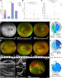 Clinical features of patients with mutations in genes for nanophthalmos