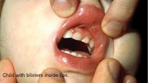 Image result for Hand foot and mouth disease HFMD roof of mouth