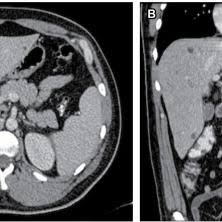 Caroli disease (communicating cavernous ectasia, or congenital cystic dilatation of the intrahepatic biliary tree) is a rare inherited disorder characterized by cystic dilatation (or ectasia) of the bile ducts within the liver. Enfermedad De Caroli