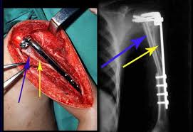 Image result for Ewing Sarcoma