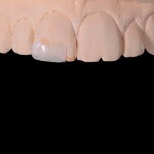 Check spelling or type a new query. How To Fix A Chipped Tooth Repair Treatment Guide