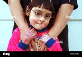 Epidermolysis bullosa hi-res stock photography and images