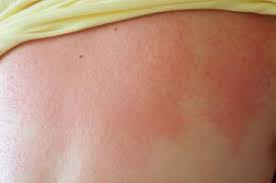 Image result for sweat rash on back