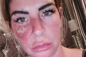 Mum issues warning after nasal tanning spray horror