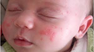 Image result for sweat rash on back baby
