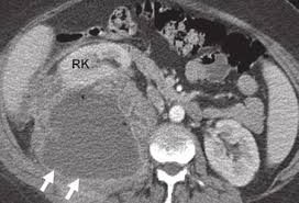 Image result for Perinephric Abscess