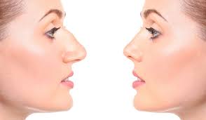 Not too happy with the way your nose looks? Nose Job Pasadena Revision Rhinoplasty Los Angeles Dr Panossian