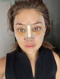 Simone Biles' plastic surgery spotlights rise of women under 30 having  major work done: 'Seismic shift'